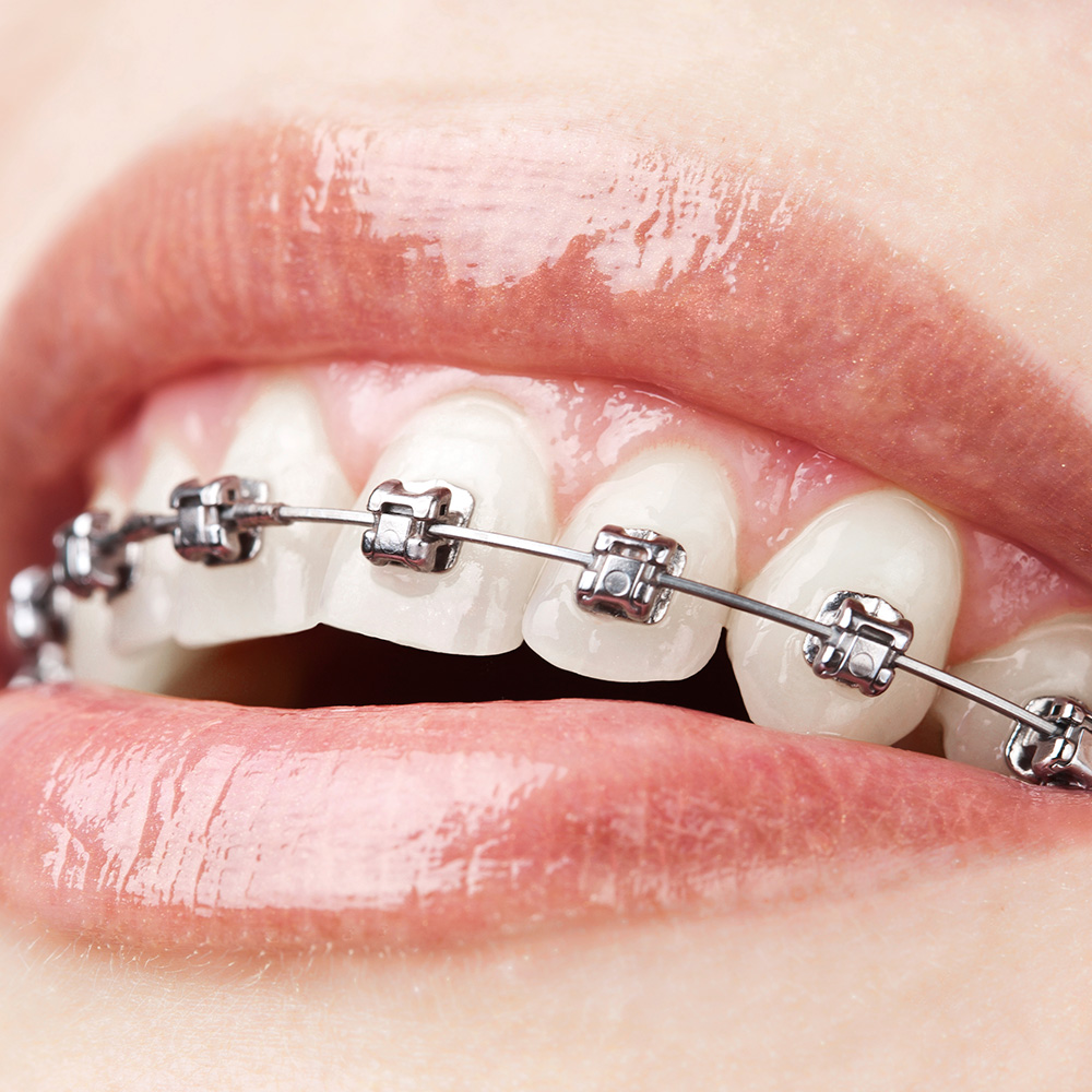 Wundstellen können durch Zahnspangen hervorgerufen werden. Eine Frau lächelt in die Kamera und zeigt ihre festsitzende Zahnspange.